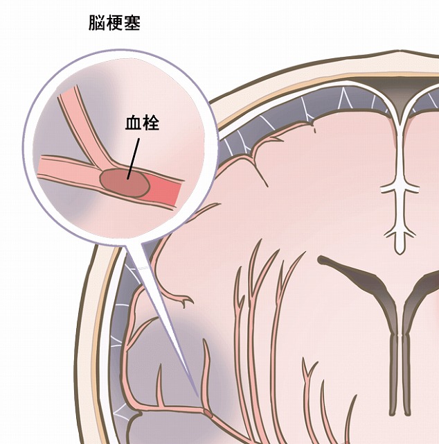 血管が詰まるタイプ