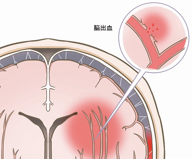 後ろ が 痛い 頭 左 くも膜下出血の3つの前兆！頭痛と目の異常に要注意