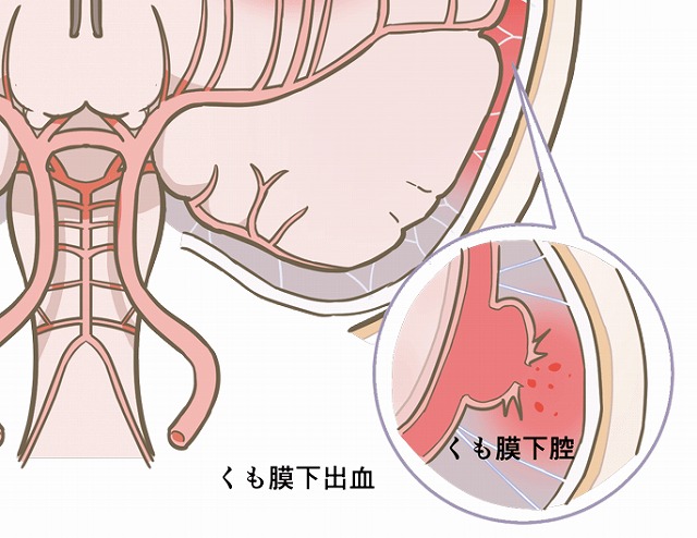 頭痛外来 命にかかわる頭痛と それほど心配のない頭痛 町田市 やました内科 脳神経クリニック